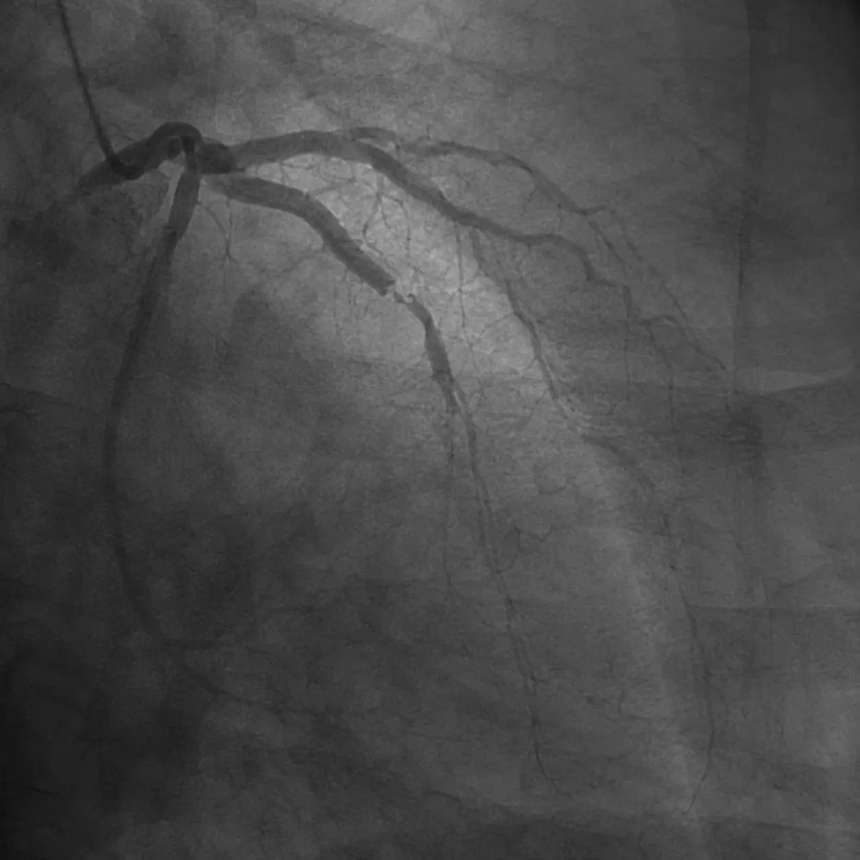 गंभीर acute coronary occlusion दिखाती coronary angiography