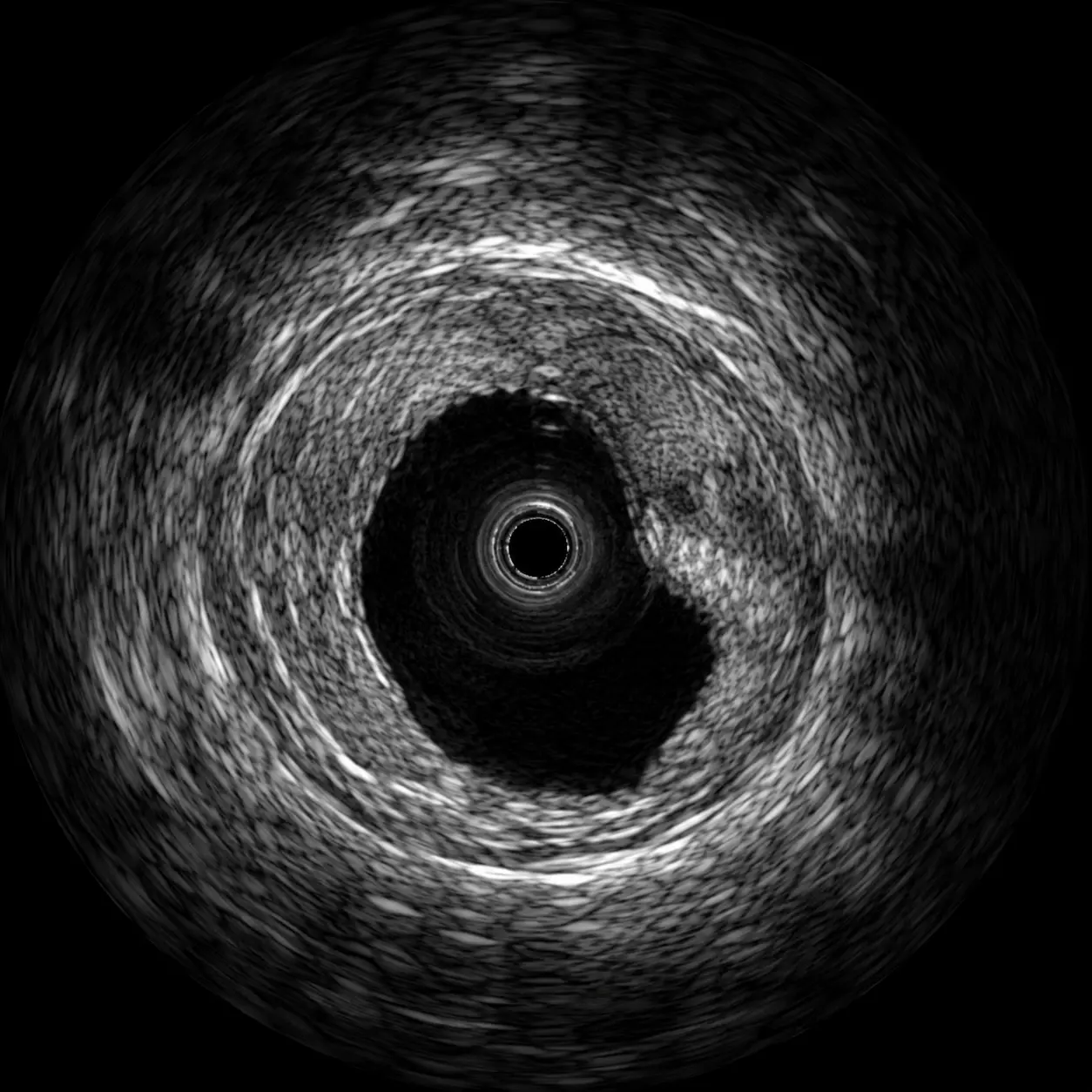 PCI के दौरान coronary plaque की IVUS imaging